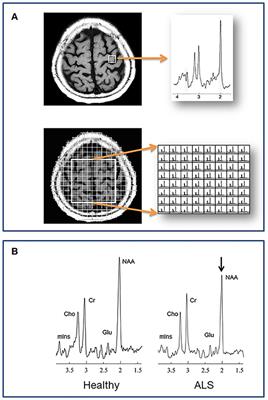 Magnetic Resonance Spectroscopy in ALS